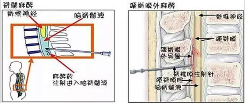 椎管进脂肪—椎管进脂肪：肥胖根源与治疗新方向-第1张图片-健康养生经验分享