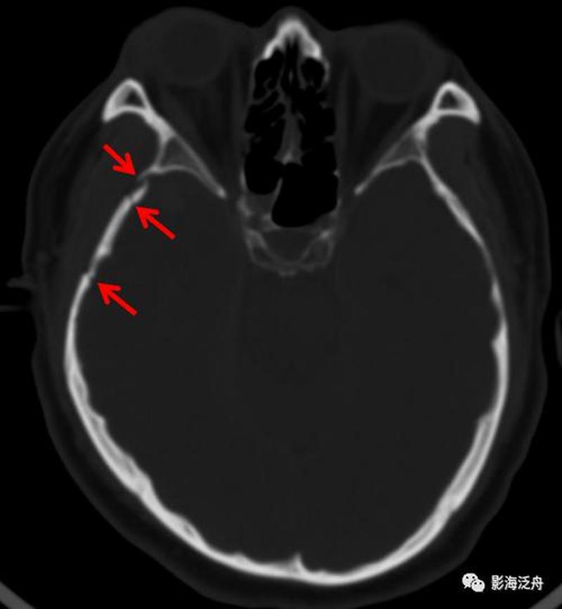 枕骨骨折严重吗_枕骨骨折的严重程度评估与治疗方案详解-第1张图片-健康养生经验分享
