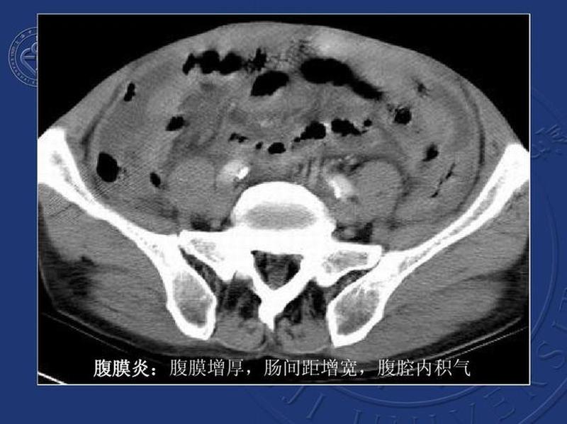 自发性腹膜炎_自发性腹膜炎：隐匿的腹腔杀手-第1张图片-健康养生经验分享