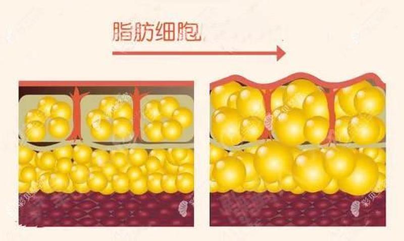 脂肪瘤怎么消除_一招击退脂肪瘤，轻松恢复窈窕-第1张图片-健康养生经验分享