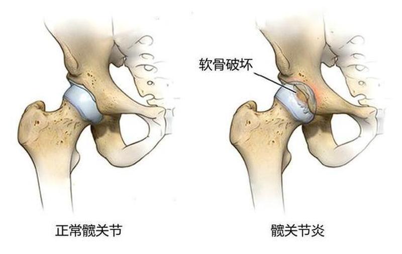 孕妇臀部疼痛什么原因_孕妇臀部剧痛：产前预警信号-第1张图片-健康养生经验分享