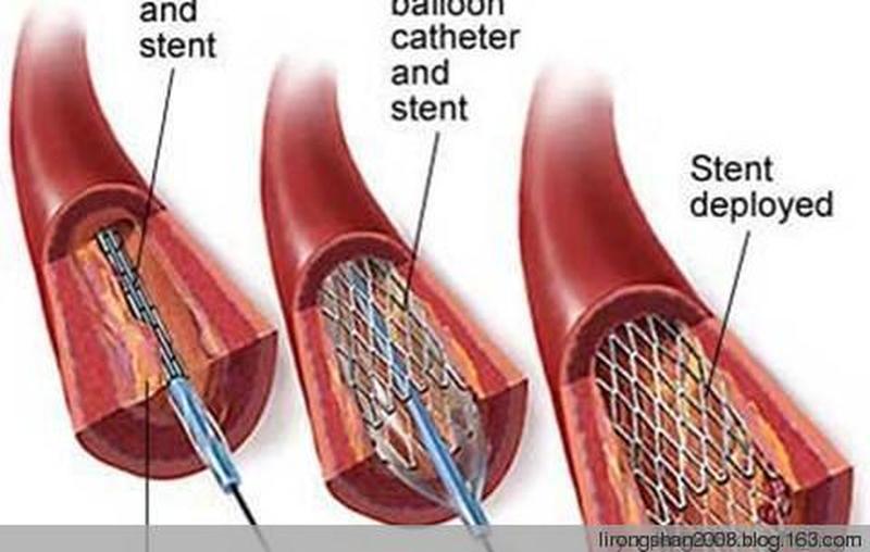 做完支架胸闷气短正常吗(支架置入后挥之不去的胸闷：探寻成因和缓解之道)-第1张图片-健康养生经验分享