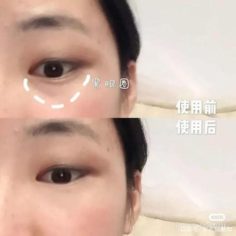 早起脸肿眼肿怎么消肿_晨曦浮肿：解开脸肿眼肿之谜-第1张图片-健康养生经验分享