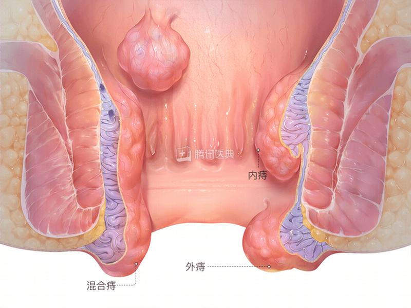 痔疮手术不疼—告别疼痛，痔疮手术新突破，轻松摆脱困扰-第1张图片-健康养生经验分享