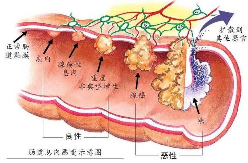 直肠多发息肉(直肠多发息肉是什么原因造成的)-第1张图片-健康养生经验分享