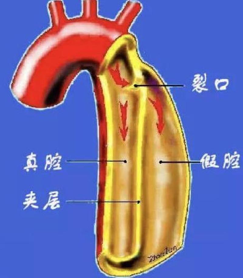 心脏主动脉(心脏主动脉夹层是什么病)-第1张图片-健康养生经验分享