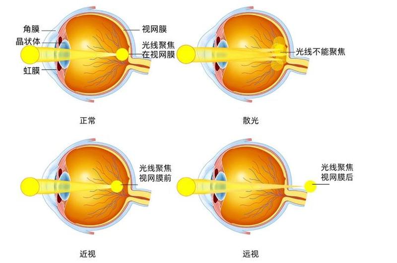 远视眼怎么矫正(远视眼怎么矫正手术)-第1张图片-健康养生经验分享