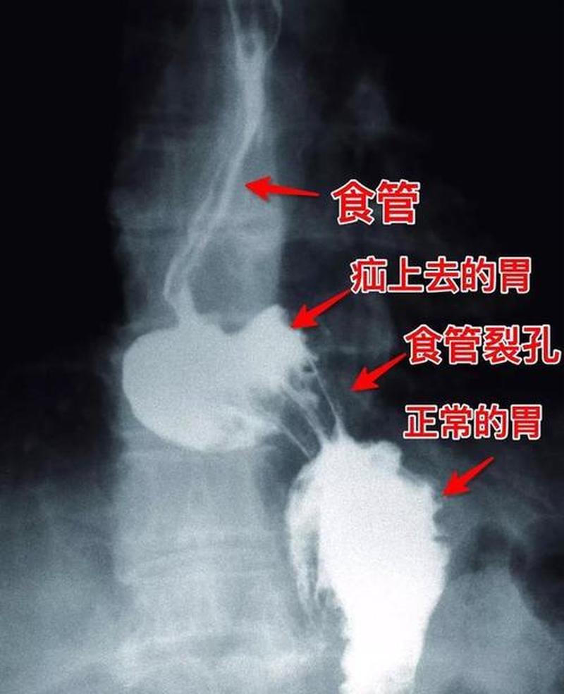 食管裂孔疝_食管裂孔疝：成因、症状、诊断与治疗-第1张图片-健康养生经验分享