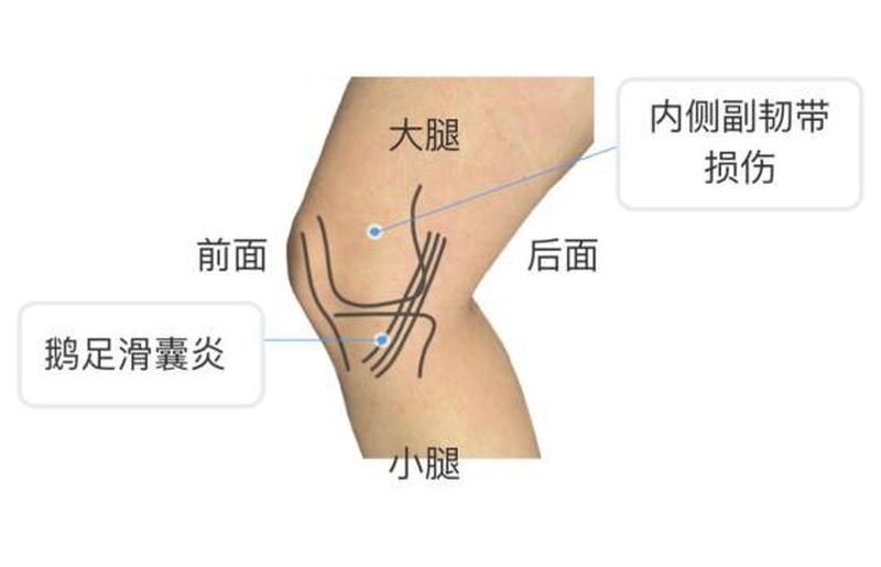 内侧疼痛—内侧疼痛的原因-第1张图片-健康养生经验分享