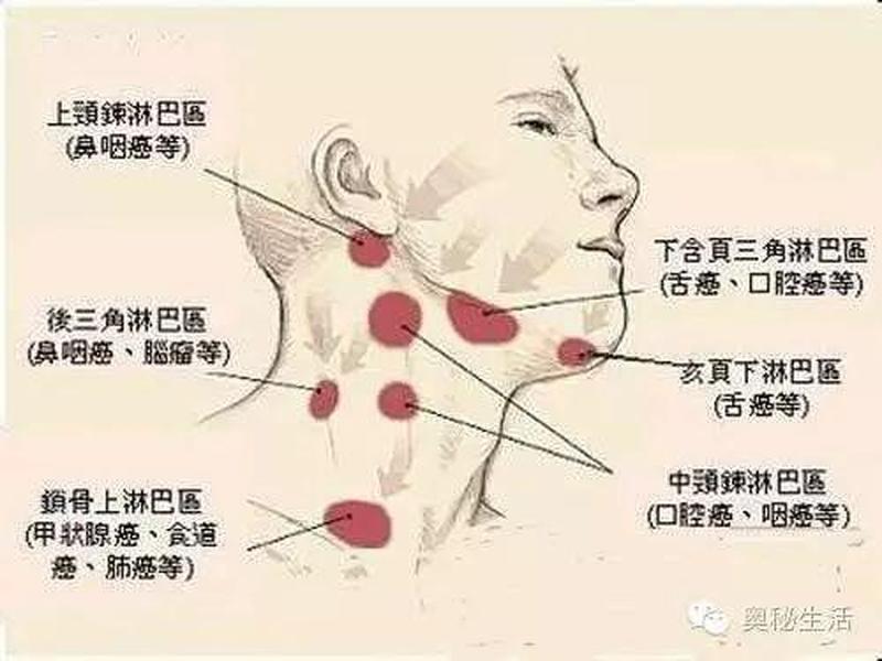 右面脖子疼_右颈疼痛：病因鉴别与缓解之道-第1张图片-健康养生经验分享