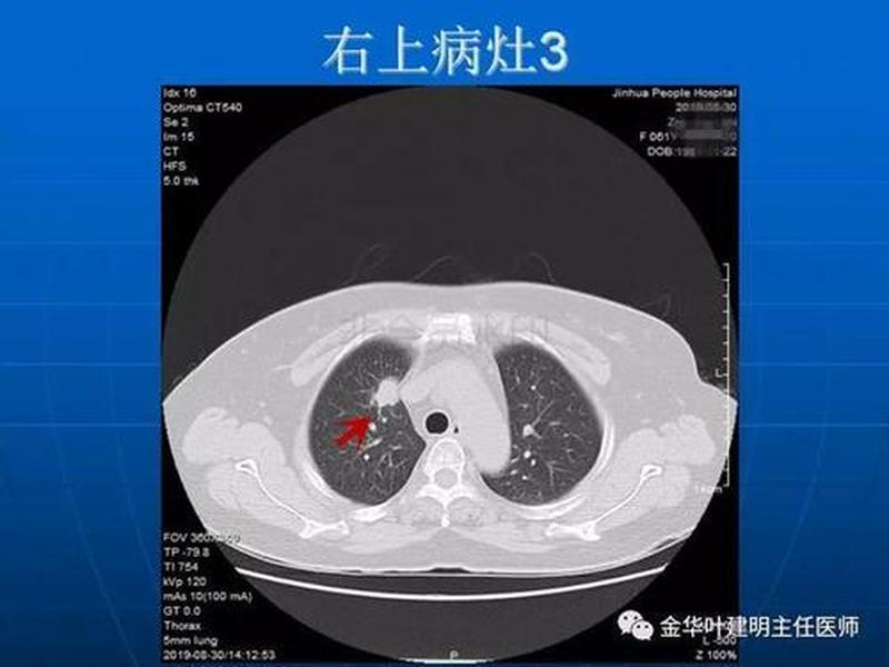 肺上有淋巴_肺上有淋巴结吗-第1张图片-健康养生经验分享