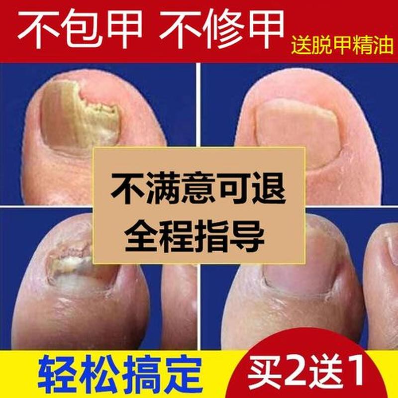 指甲与甲床分离(指甲与甲床脱离还能长出来吗)-第1张图片-健康养生经验分享