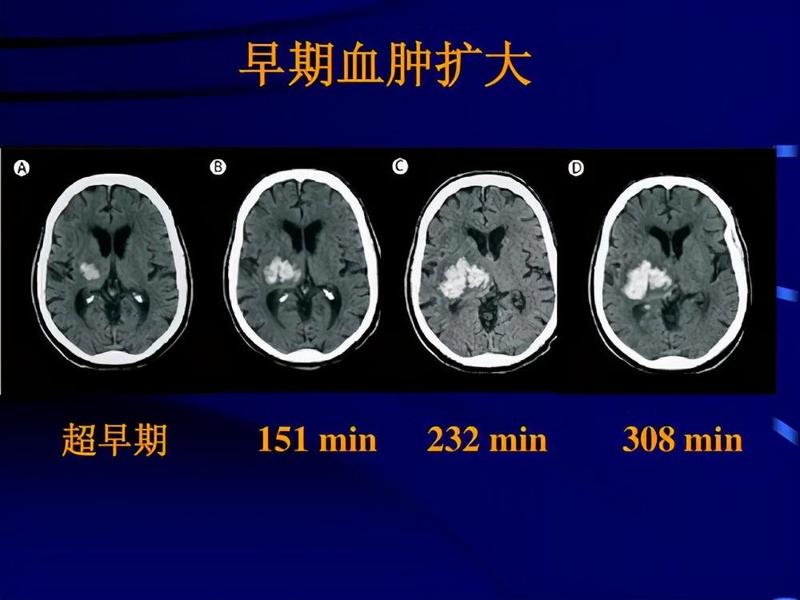 蛛网膜出血_蛛网膜出血恢复了好正常人一样吗-第1张图片-健康养生经验分享