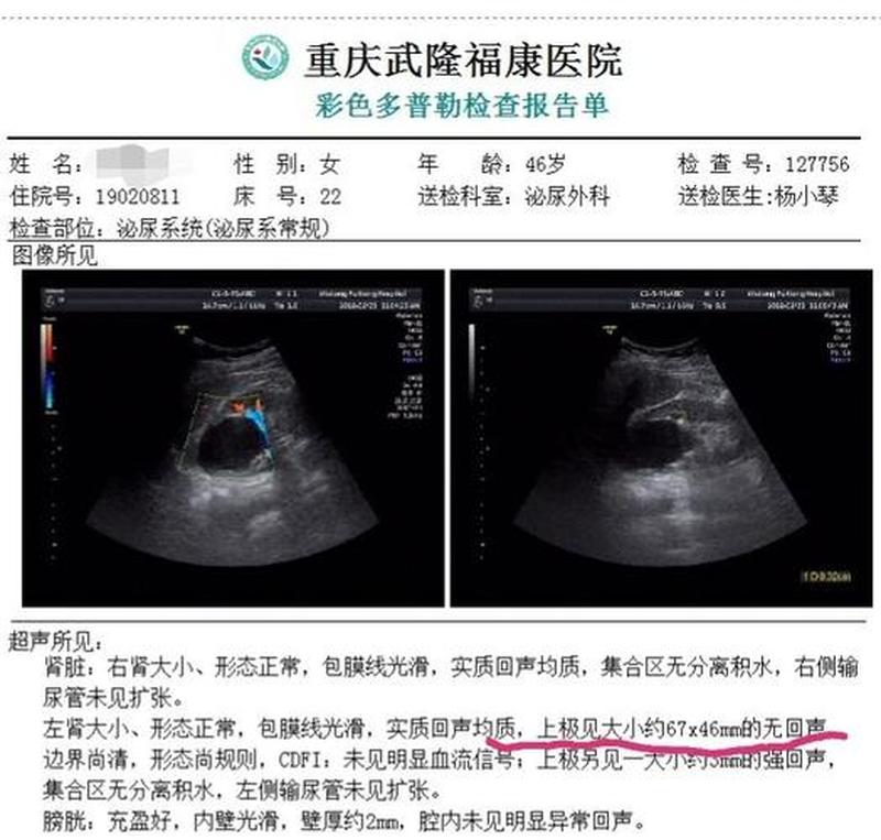 右肾无回声_右肾无回声暗区考虑囊肿是什么意思-第1张图片-健康养生经验分享