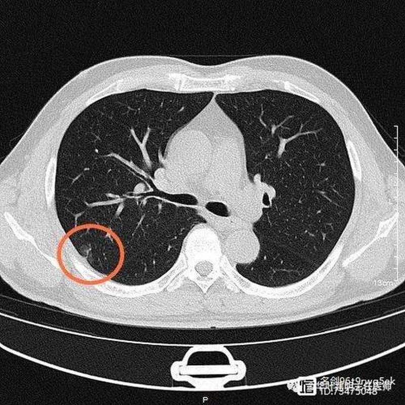 右肺磨玻璃结节_右肺磨玻璃结节6mm严重吗-第1张图片-健康养生经验分享