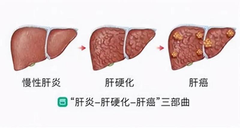 转氨酶44.2严重吗_转氨酶44.96：肝病隐形杀手，亟需关注-第1张图片-健康养生经验分享