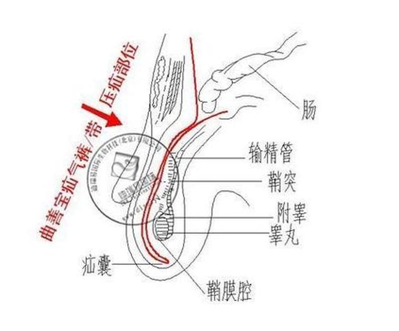 婴儿鞘膜积液(鞘膜积液的识别与早期干预：保障男婴阴囊健康发育)-第1张图片-健康养生经验分享