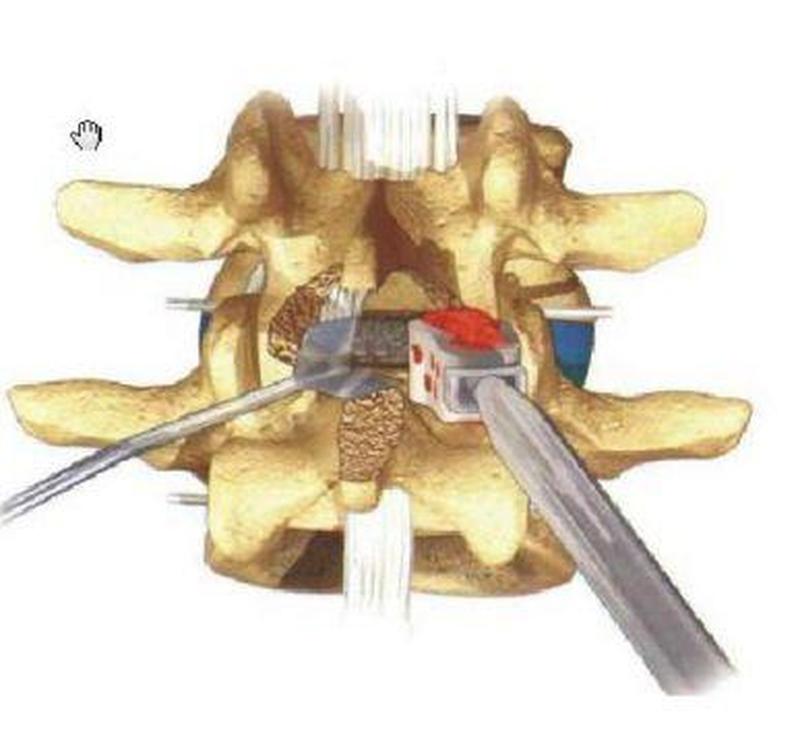 腰椎融合手术_脊柱稳定术：腰椎融合手术探秘-第1张图片-健康养生经验分享