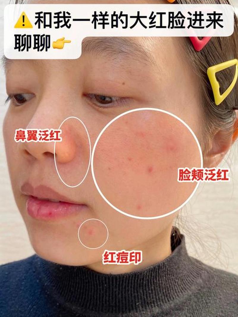 婴儿脸上发红_婴儿面颊泛红：解读原因和处理 *** -第1张图片-健康养生经验分享