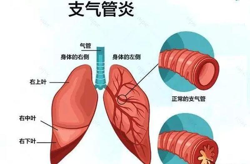 支气管炎如何治疗—支气管炎根治指南：症状、诊断和有效疗法-第1张图片-健康养生经验分享