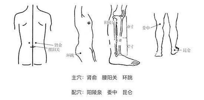 右侧坐骨痛怎么办—揭秘右侧坐骨痛的隐秘真相，释放无痛生活-第1张图片-健康养生经验分享