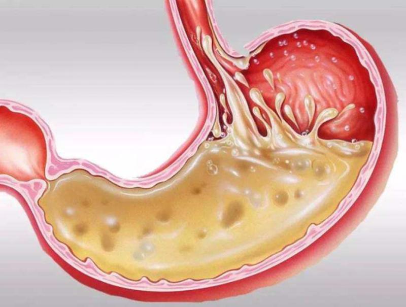 早上起来胃酸怎么办(清晨胃酸逆流：如何唤醒沉睡的胃)-第1张图片-健康养生经验分享