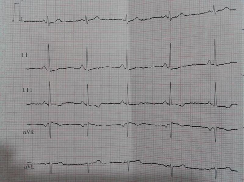 孕妇心电图前壁t波异常(前壁T波异常：从心电图异常探究心脏健康隐患)-第1张图片-健康养生经验分享