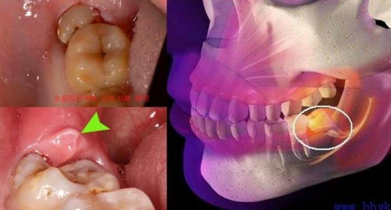 智齿为什么会发炎_智齿为什么会发炎肿痛图片-第1张图片-健康养生经验分享