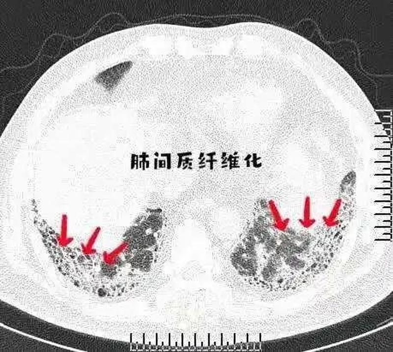 左肺高密度影—左肺高密度影是什么意思-第1张图片-健康养生经验分享