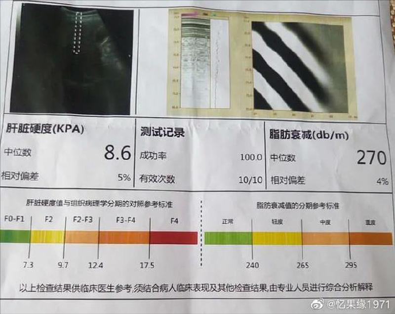 脂肪肝看哪个指标(脂肪肝标准值是多少正常)-第1张图片-健康养生经验分享