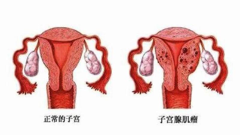 子宫肥大怎么治疗效果快啊图片—子宫肥大治疗指南：非手术和手术方式详解-第1张图片-健康养生经验分享