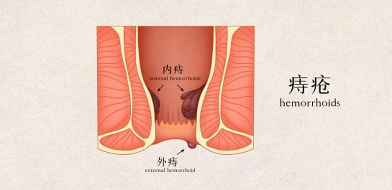 在家痔疮犯了怎么办_痔上眉梢，挥之不去的回家噩梦-第1张图片-健康养生经验分享