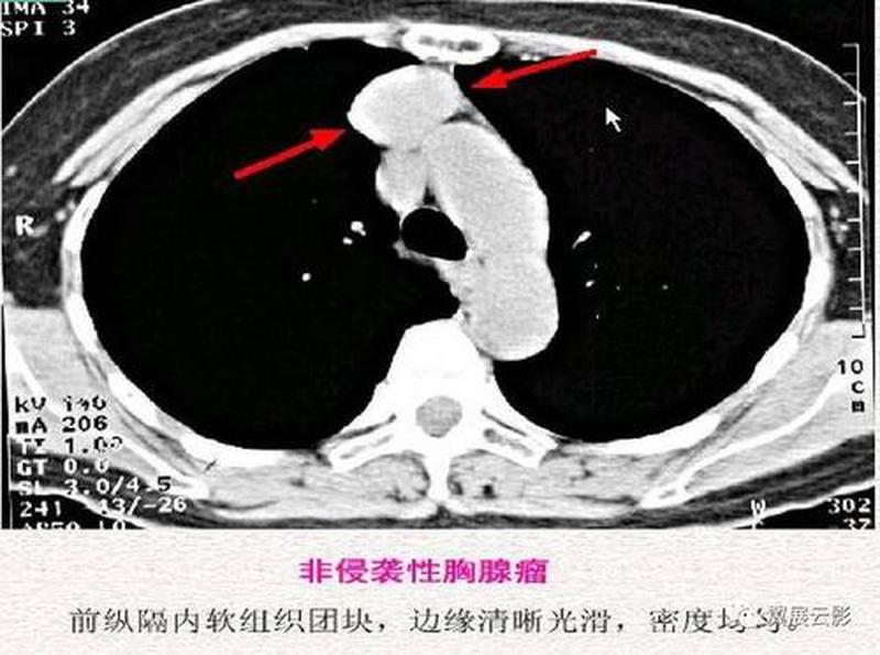 纵隔小结节—纵隔小结节影像学特征及其临床意义探讨-第1张图片-健康养生经验分享