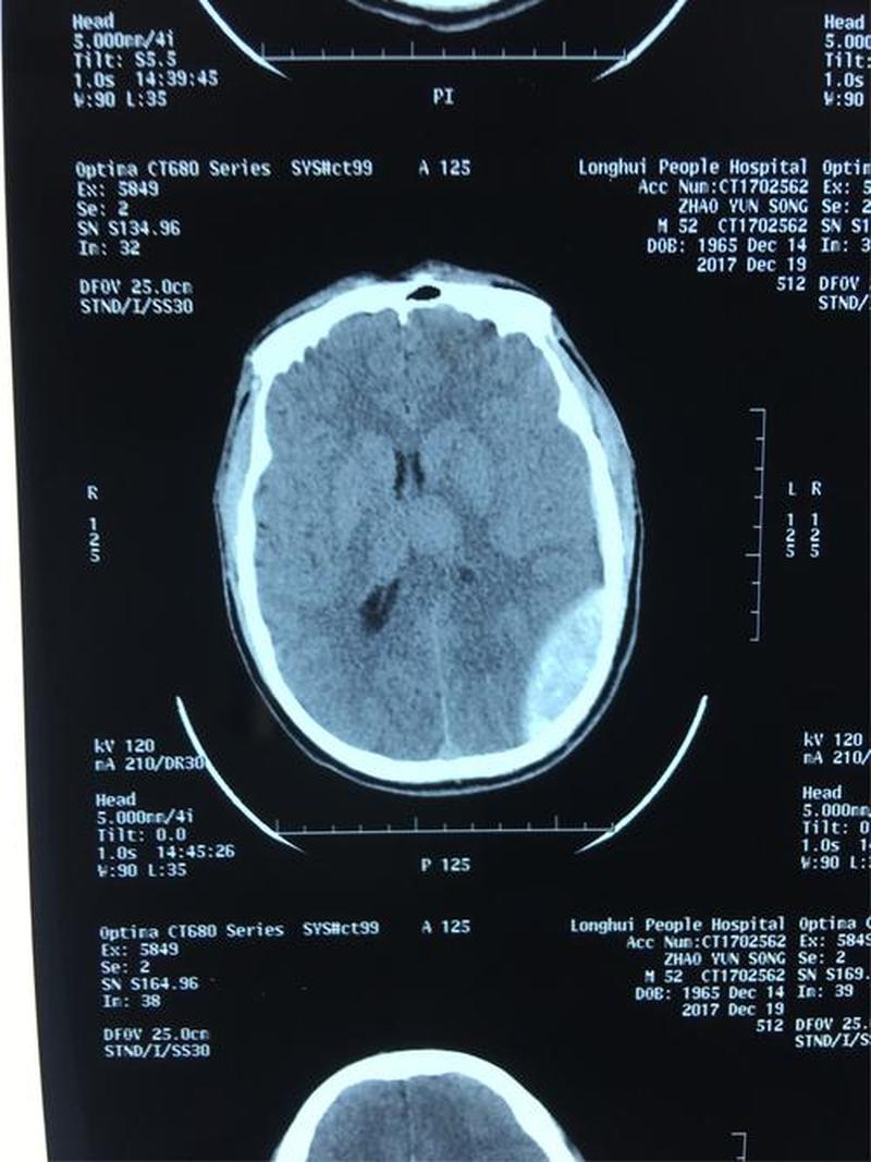 做脑部ct头晕—脑CT检查后眩晕原因探讨-第1张图片-健康养生经验分享