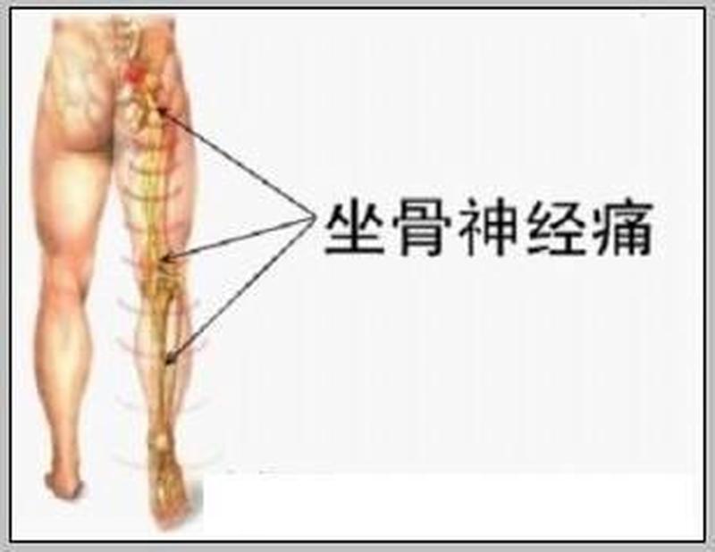 大腿的神经疼_大腿神经痛：隐痛刺痛，难以忍受-第1张图片-健康养生经验分享