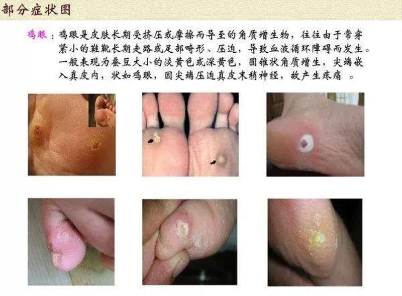 整个脚底板疼是什么原因引起的(脚底板周全剧痛，寻根探源解不适)-第1张图片-健康养生经验分享