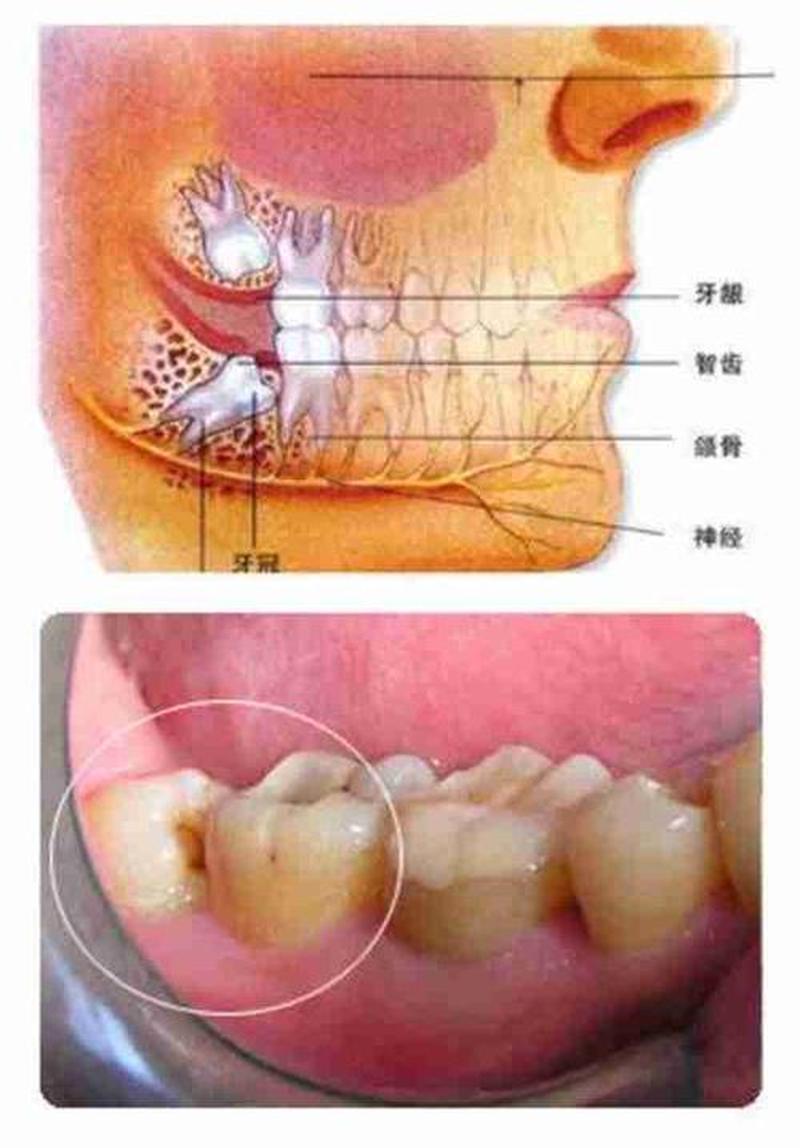 智齿是什么(智齿是什么原因)-第1张图片-健康养生经验分享