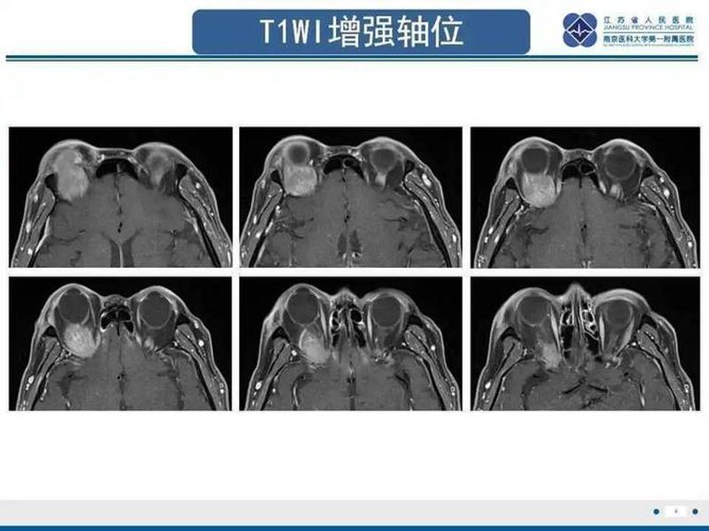 右脑痛右眼睛胀痛(右眼胀痛难忍 困扰难消)-第1张图片-健康养生经验分享