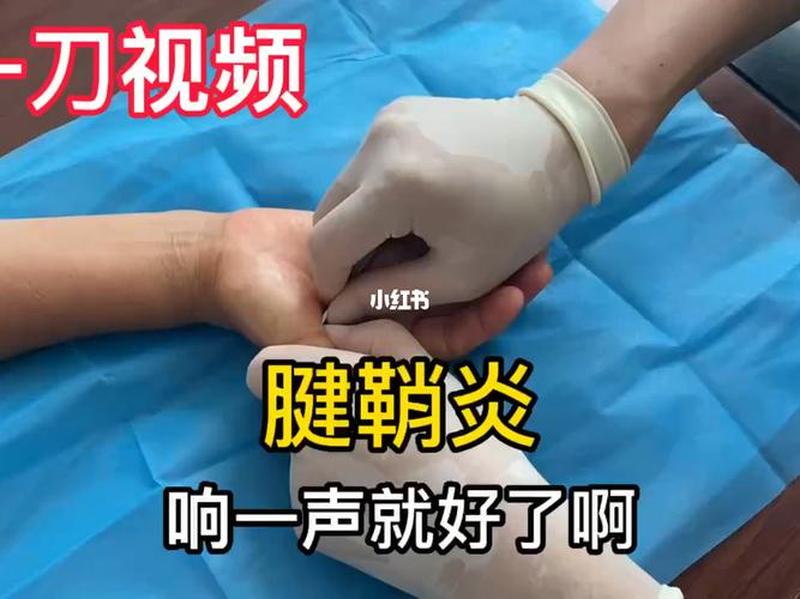 怎么治疗腱鞘炎_怎么治疗腱鞘炎更好-第1张图片-健康养生经验分享