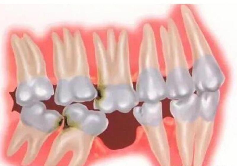 孕妇可以拔牙齿吗剂_孕妇拔牙安全，解除产前牙痛困扰-第1张图片-健康养生经验分享