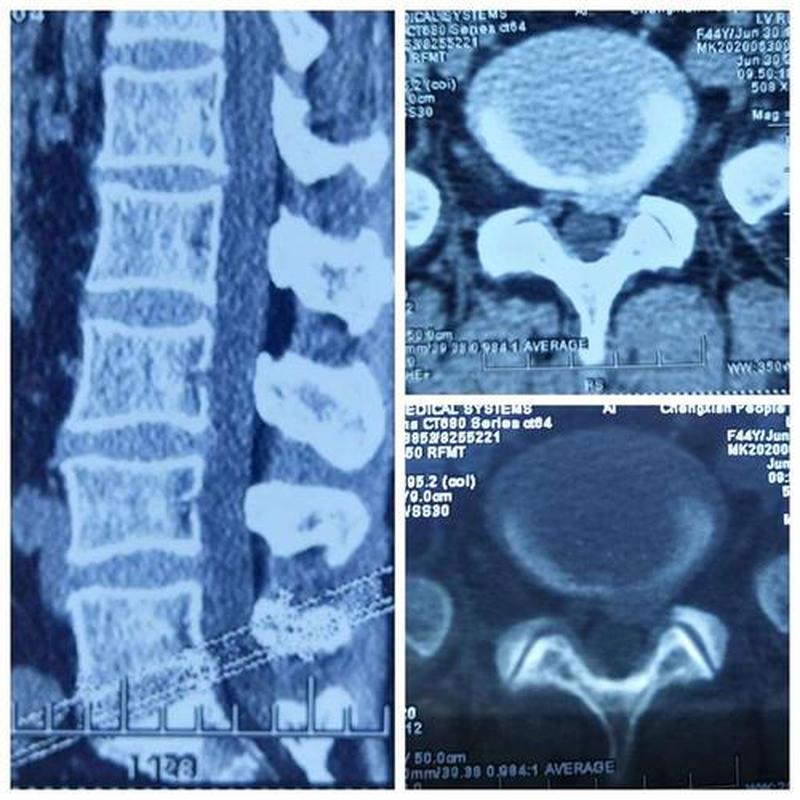 椎间盘的临床意义不包括_椎间盘病变的临床表现、诊断与治疗策略-第1张图片-健康养生经验分享