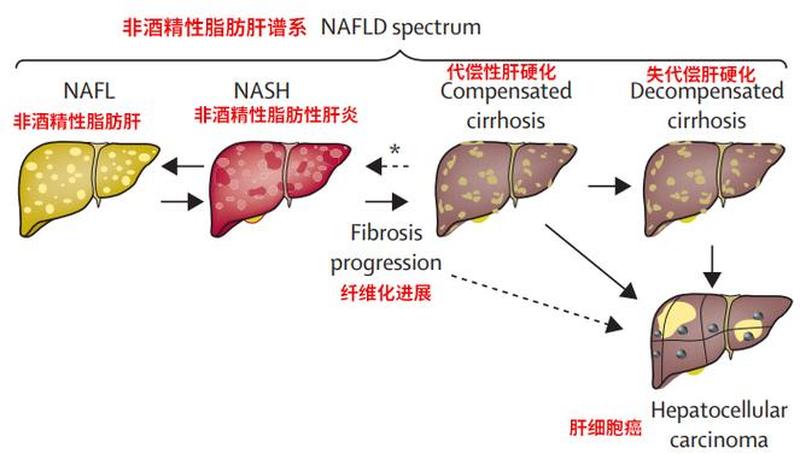 脂肪肝原因(揭开脂肪肝的成因之谜：从病理到生活方式)-第1张图片-健康养生经验分享