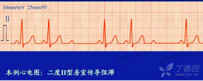 心电图有杂音(心电图有杂音能当兵吗)-第1张图片-健康养生经验分享