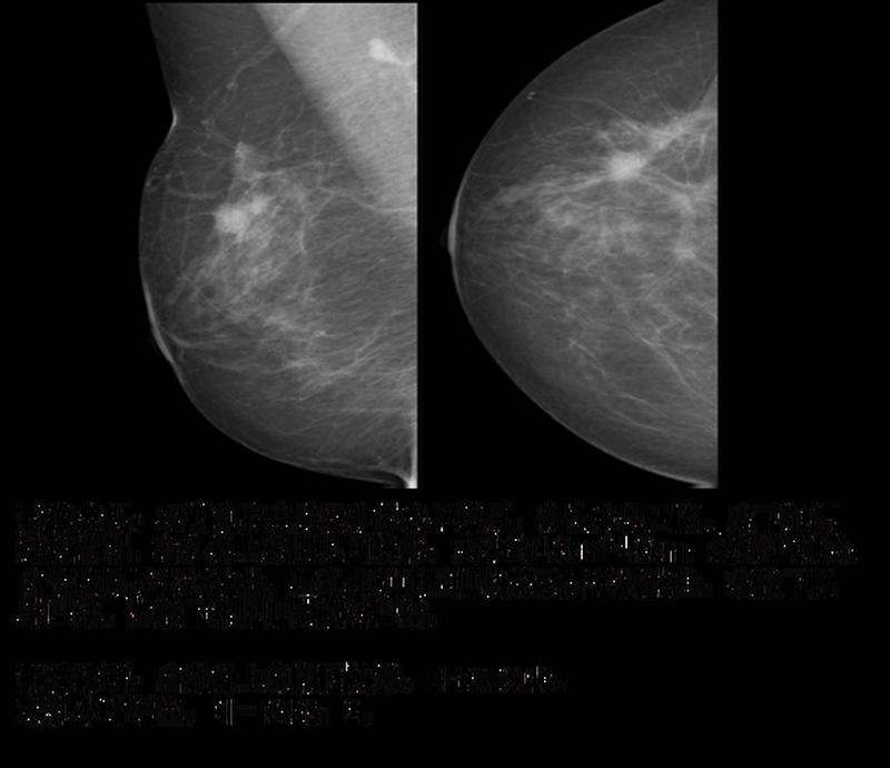 有阴影一定是乳腺癌吗(乳影浮沉，探秘健康隐忧)-第1张图片-健康养生经验分享