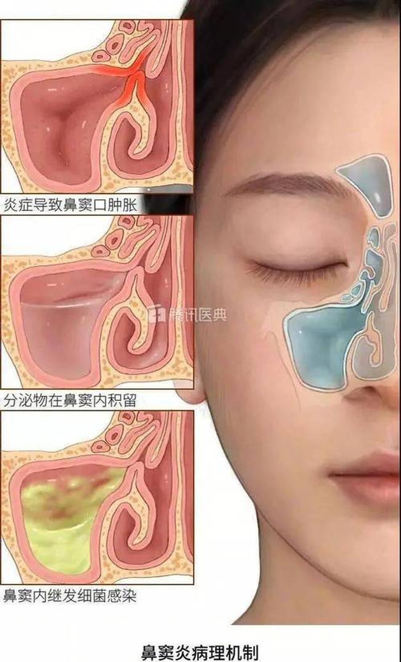 有黄绿鼻涕(鼻涕呈黄绿 呼吸道感染的信号)-第1张图片-健康养生经验分享