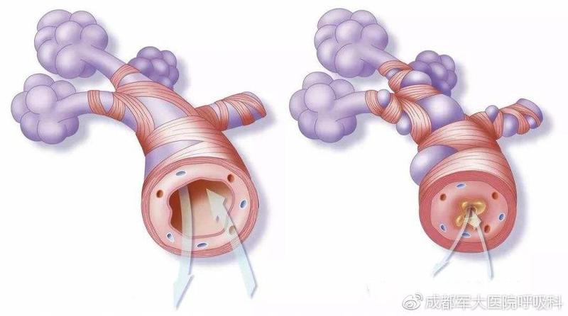 支气管炎的症状和肺炎的区别(支气管炎的警示信号：留意这些呼吸道症状)-第1张图片-健康养生经验分享