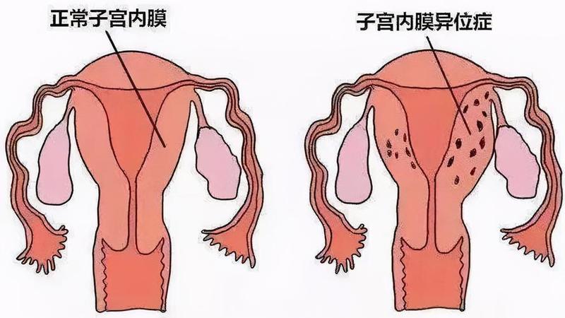 子宫内膜不均—子宫内膜不均：从病因到治疗策略-第1张图片-健康养生经验分享