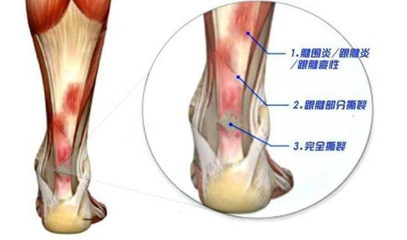 走路脚后跟很痛—走路脚后跟痛挂什么科-第1张图片-健康养生经验分享