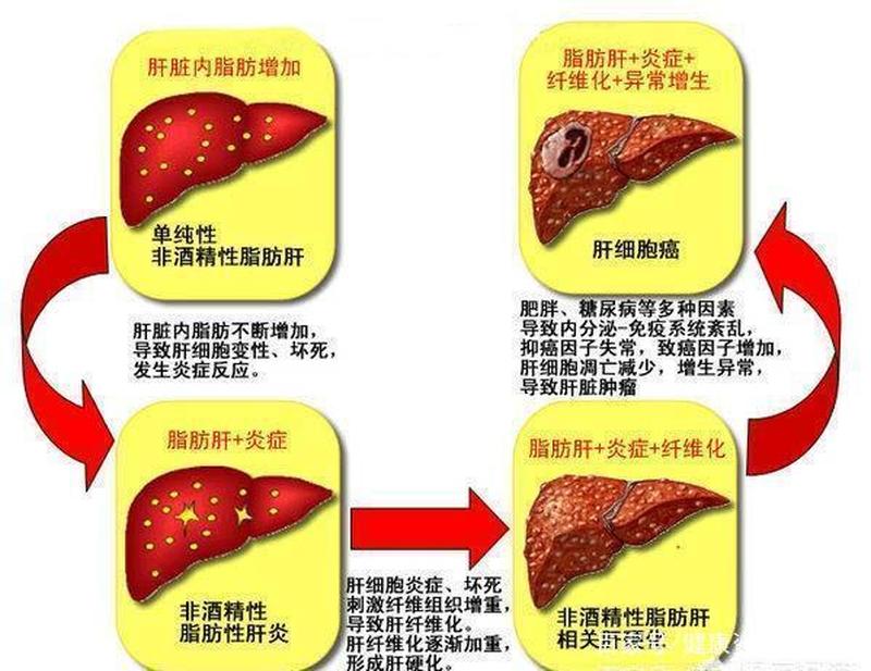 脂肪肝的危害和严重性(脂满全身，危及生命)-第1张图片-健康养生经验分享