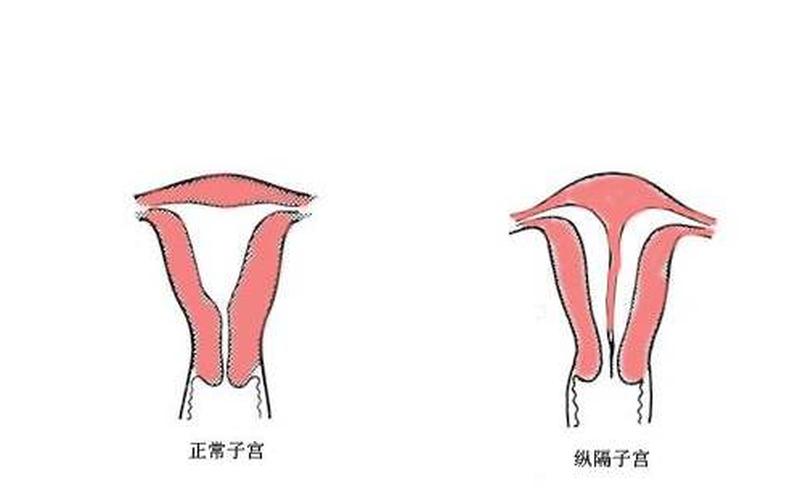 子宫先天性畸形(子宫先天性畸形图片)-第1张图片-健康养生经验分享